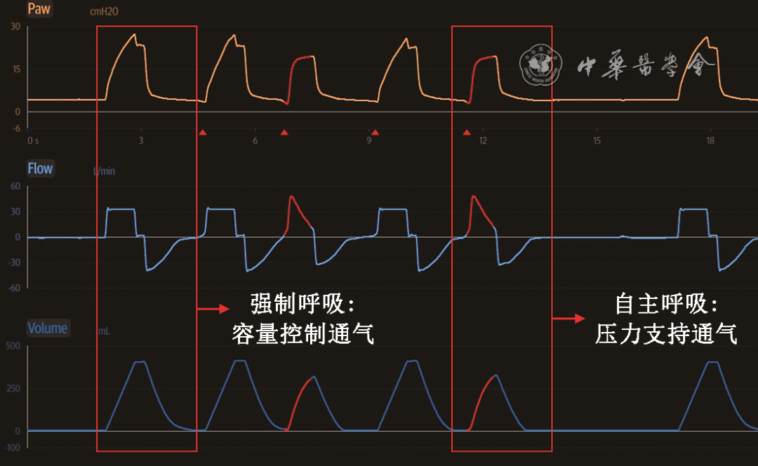 無創(chuàng)呼吸機