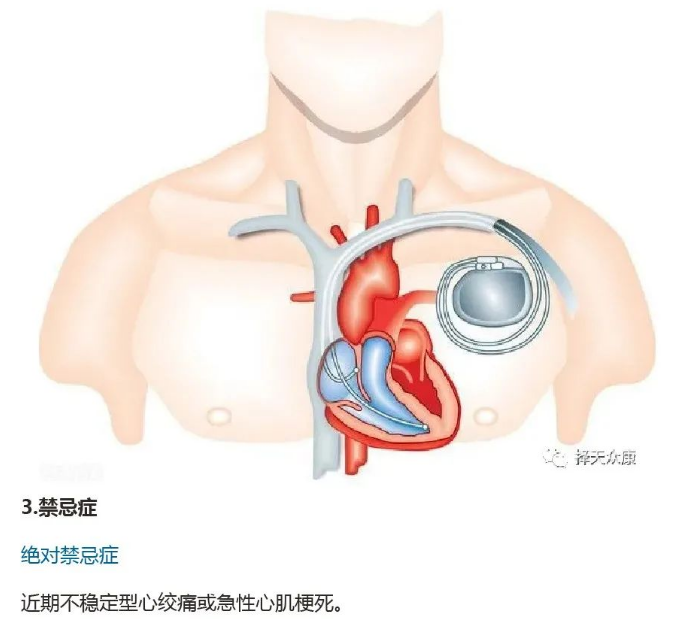 高流量耗材,呼吸機耗材